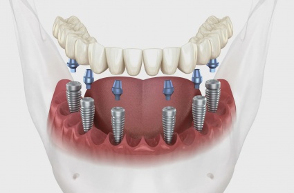 All on 6 Implant