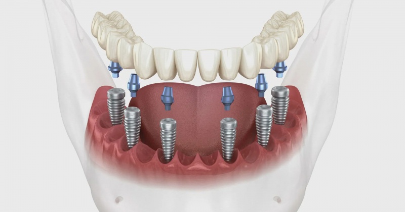 All on 6 Implant